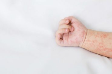 Mengenali Alergi Pada Anak