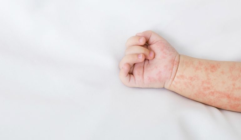 Mengenali Alergi Pada Anak